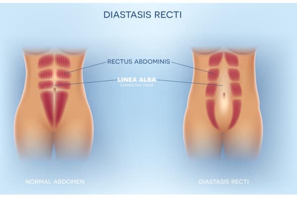 What Non-Surgical Options Are Available for Diastasis Recti South Yardley?