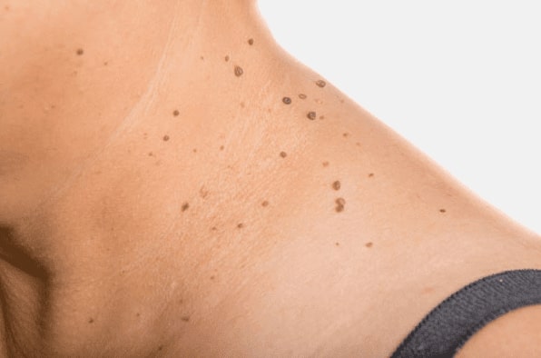 Are you looking for easy skin tag removal South Yardley - then contact Spire today!