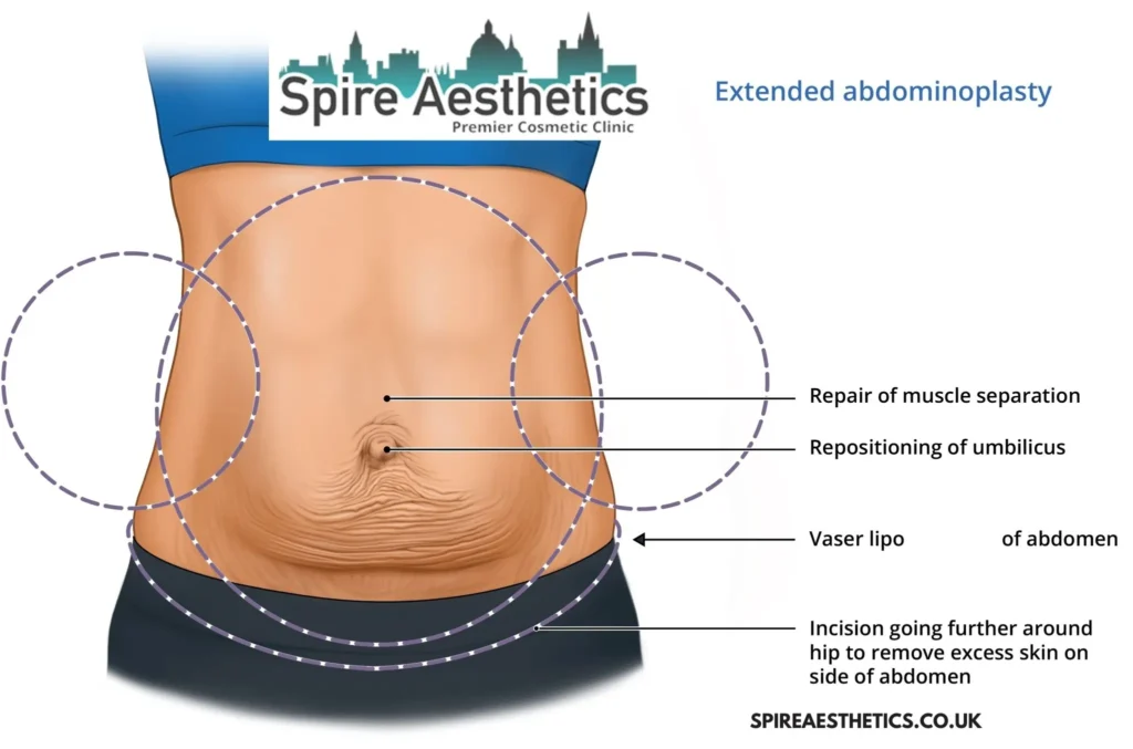 Understanding Loose Skin After Gastric Band South Yardley Surgery and HIFU Treatment