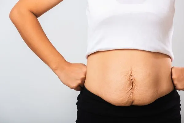 Image of a woman's stomach after weight loss with sagging skin following a gastric band South Yardley