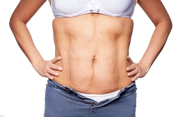 sagging skin on woman's stomach after weight loss injections South Yardley