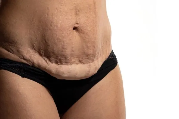 Image of womans stomach after weight loss injections South Yardley showing saggy skin
