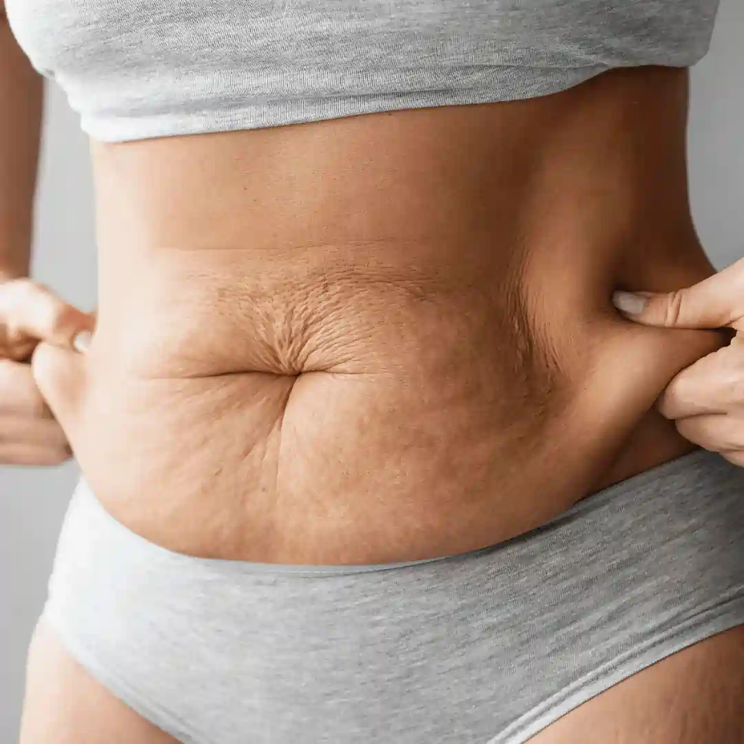 Is It Normal to Have Loose Skin After Pregnancy South Yardley?